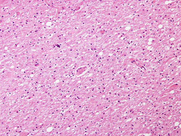 2D1 Hypoxia-Ischemia Adult White Matter (Case 2) H&E 2