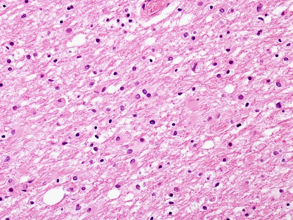 2D2 Hypoxia-Ischemia Adult White Matter (Case 2) H&E 1