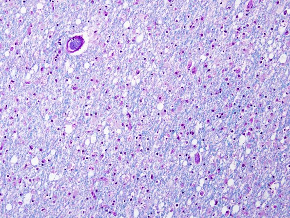 2E1 Hypoxia-Ischemia Adult White Matter (Case 2) LFB-PAS 4