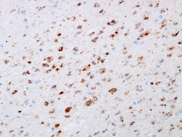 2F3 Hypoxia-Ischemia Adult White Matter (Case 2) CD68 3