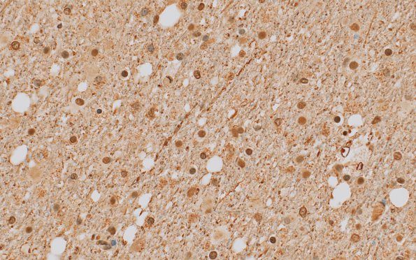 2H Hypoxia-Ischemia Adult White Matter (Case 2) N11 NF 40X