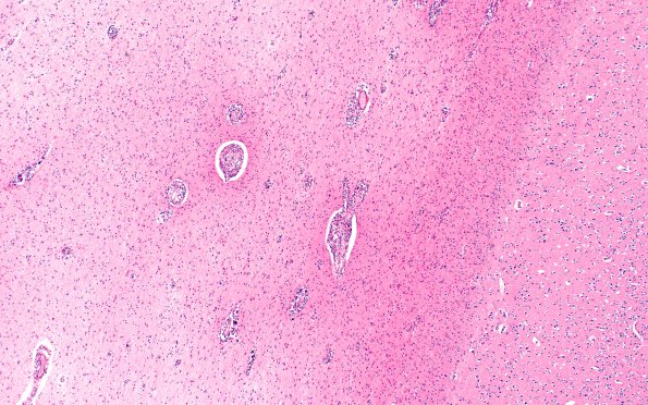 1B4 Krabbe's Disease (Case 1) 10X area B H&E 4X