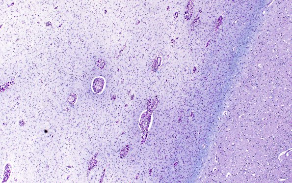 1B5 Krabbe's Disease (Case 1) 10X area B LFB-PAS 4X