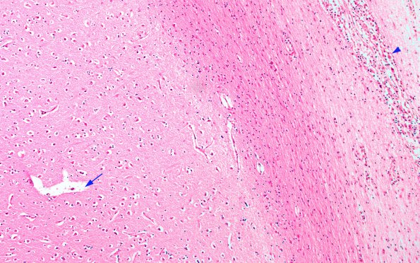 1C1 Krabbe's Disease (A36653) 10X 3 copy