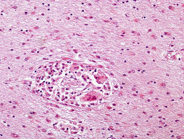 1C2 Krabbe's Disease (Case 1) H&E 2