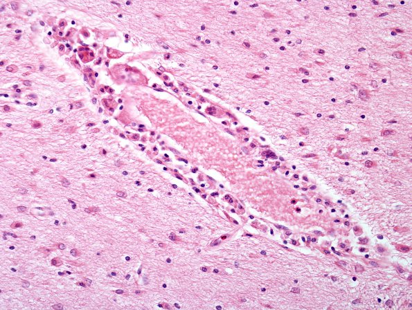 1C3 Krabbe's Disease (Case 1) H&E 1