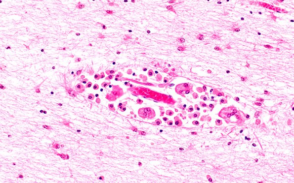 1C4 Krabbe's Disease (Case 1) 40X 2