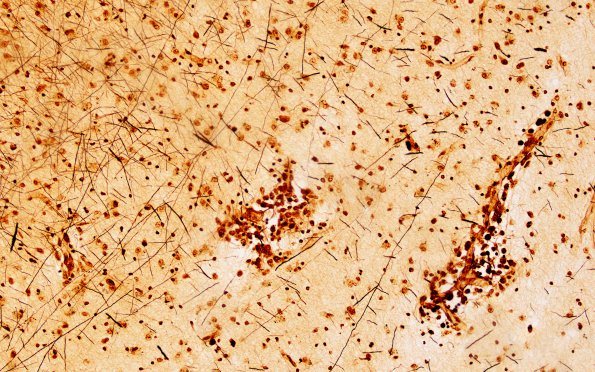 1C5 Krabbe's Disease (Case 1) 10X area near remaining myelin Biels