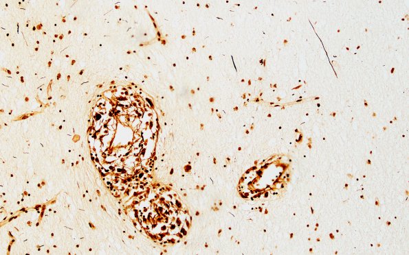 1C6 Krabbe's Disease (Case 1) 10X area without remaining myelin Biels