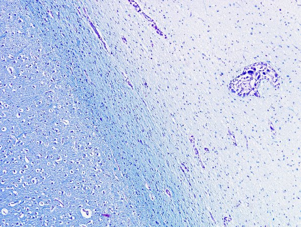 1D2 Krabbe's Disease (Case 1) LFB-PAS 1