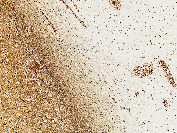 1D3 Krabbe's Disease (Case 1) Biels 1