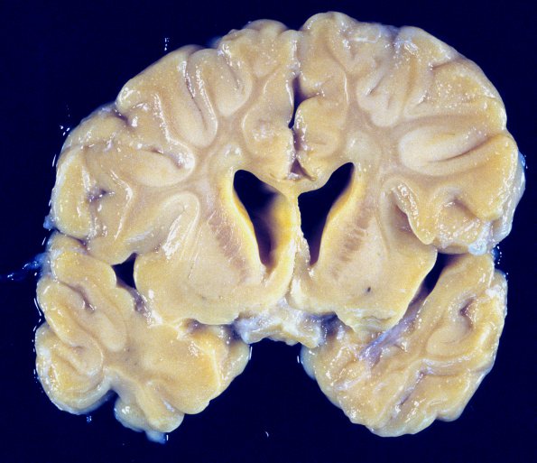 4A1 Krabbe's Disease (WUMS Case) 4A2 B