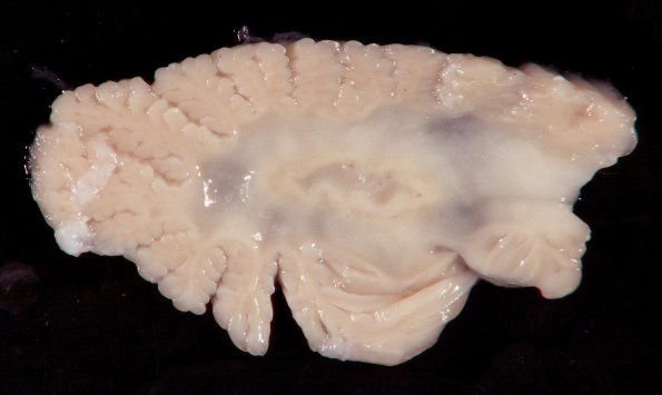 4A3 Krabbe Disease (WU Case) gross_1