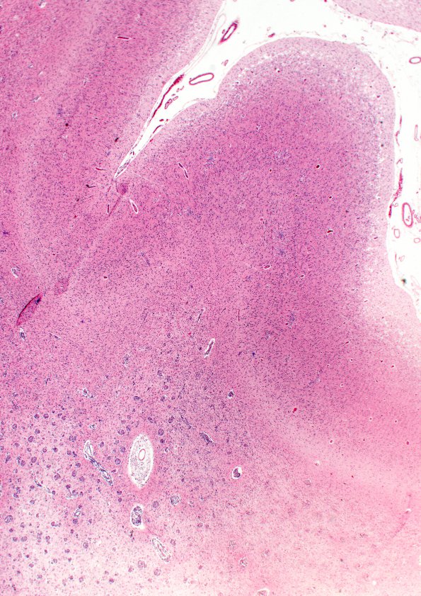 4B1 Krabbe's Disease (WUMS Case) 4A2 B 2X