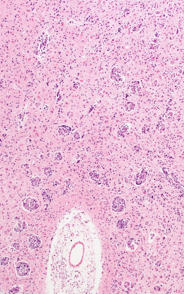 4B2 Krabbe's Disease (WUMS Case) 4A2 B 10X