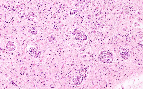 4B3 Krabbe's Disease (WUMS Case) 4A2 B 20X