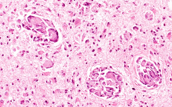 4B4 Krabbe's Disease (WUMS Case) 4A2 B 40X