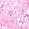 4B5 Krabbe's Disease (WUMS Case) 4A2 B 20X 2