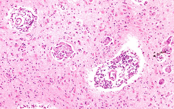 4B5 Krabbe's Disease (WUMS Case) 4A2 B 20X 2