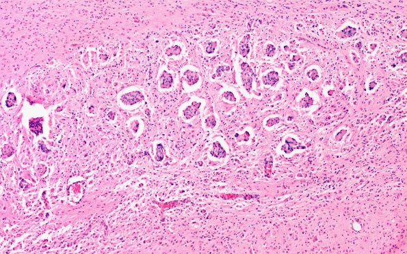 4C3 Krabbe's Disease (WUMS Case) 10X 2