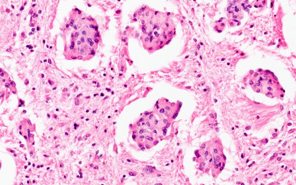 4C4 Krabbe's Disease (WUMS Case) pons 40X