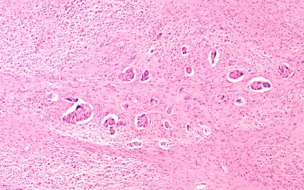 4C5 Krabbe's Disease (WUMS Case) 10X