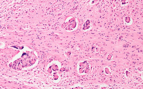 4C6 Krabbe's Disease (WUMS Case) 20X