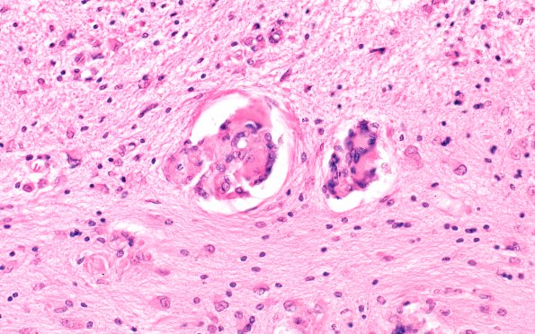 4C7 Krabbe's Disease (WUMS Case) 40X