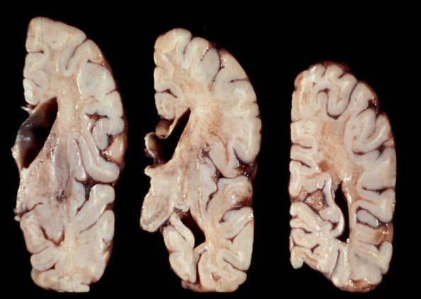 1A1 Metachromatic Leukodystrophy (Case 1) 1