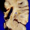 1A2 Metachromatic Leukodystrophy (Case 1) 12 copy