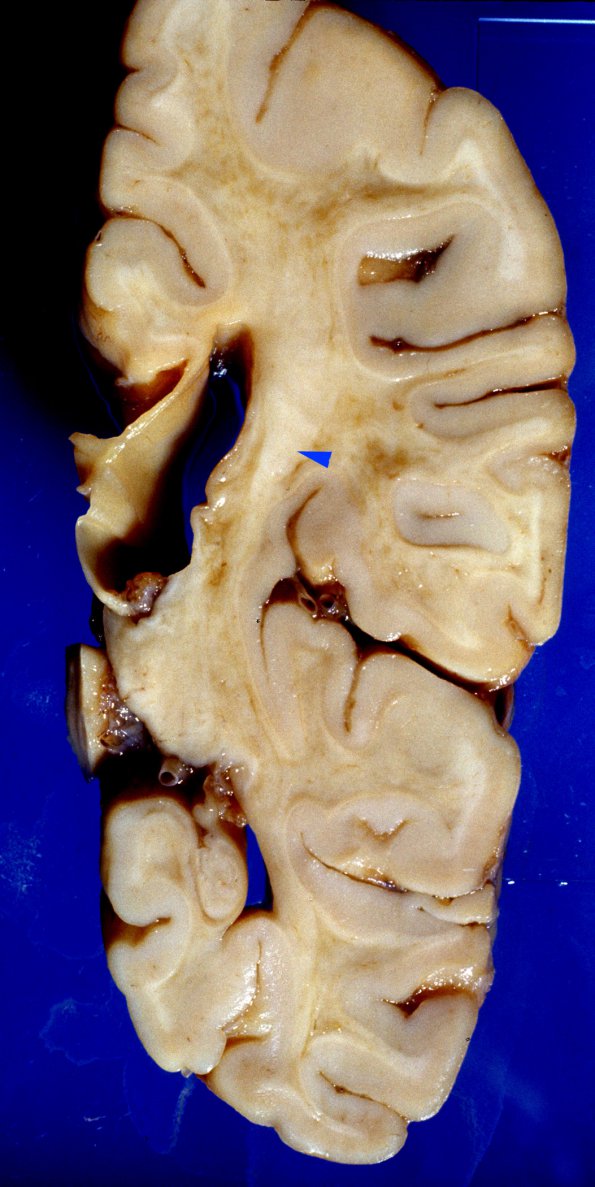 1A2 Metachromatic Leukodystrophy (Case 1) 12 copy