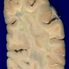 1A4 Metachromatic Leukodystrophy (Case 1) 3