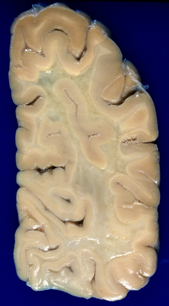 1A4 Metachromatic Leukodystrophy (Case 1) 3