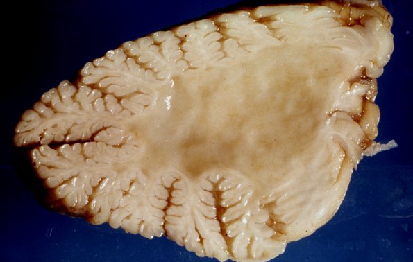 1A6 Metachromatic Leukodystrophy (Case 1) 13