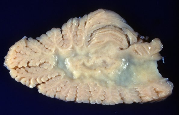 1A7 Metachromatic Leukodystrophy (Case 1) 9