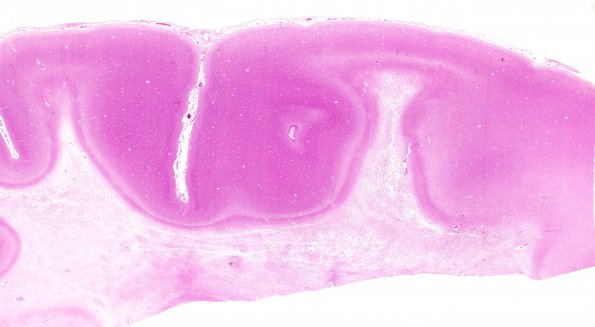 1B1 MLD (Case 1) 1 H&E cortex WM