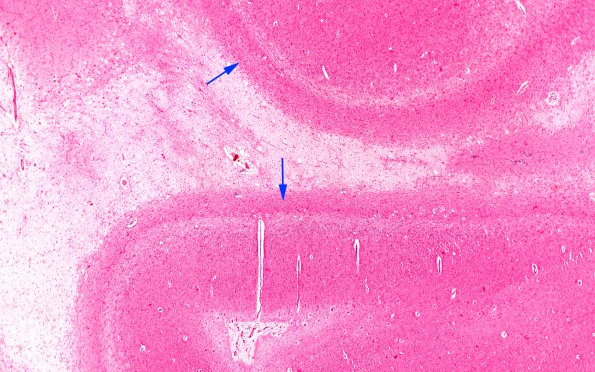 1B2 Metachromatic Leukodystrophy (Case 1) cerebral cortex 9813 copy