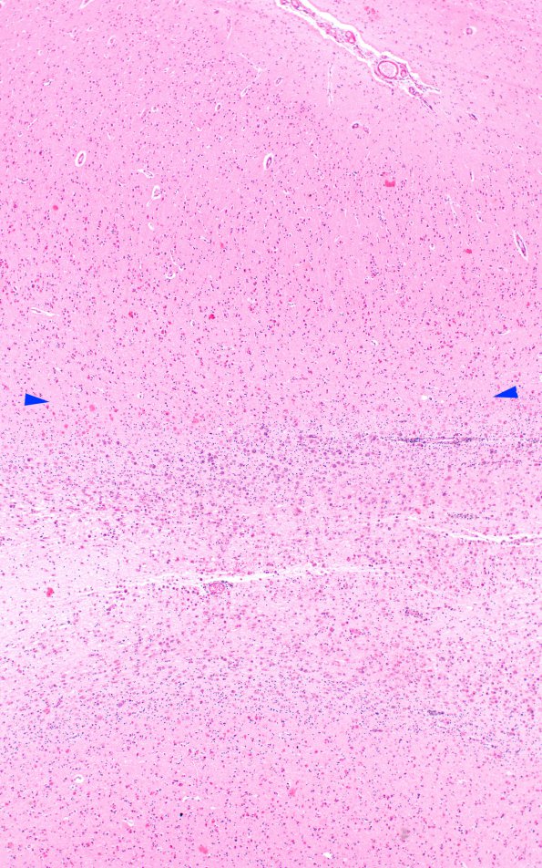 1B3 MLD (Case 1) 1 LFB-PAS cerebral cortex H&E 4X 1 copy