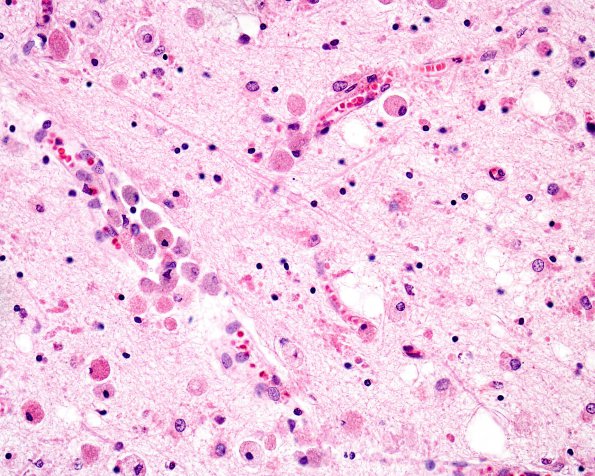 1B5 Metachromatic Leukodystrophy (Case 1) H&E 1