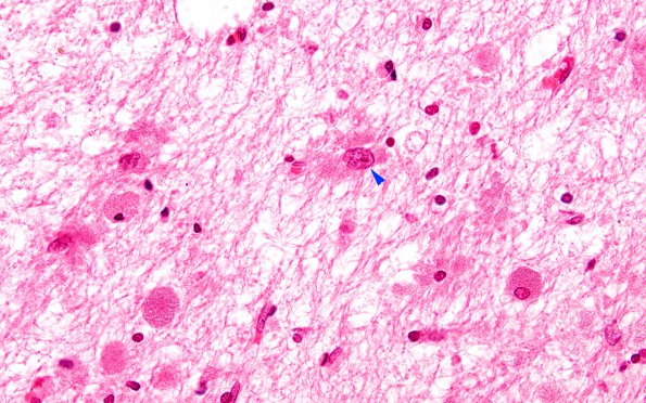 1B7 Metachromatic Leukodystrophy (Case 1) cortex 9837 60X copy