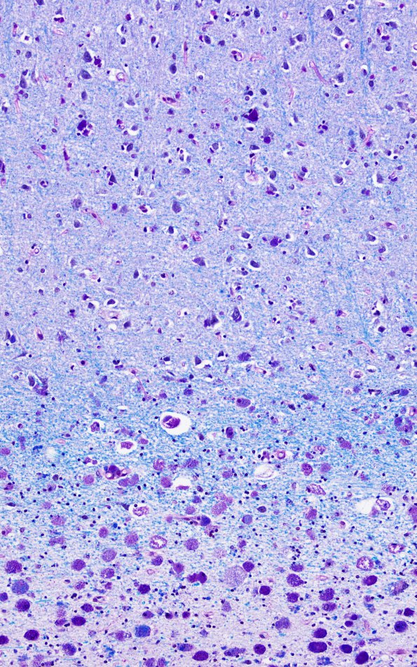 1C2 MLD (Case 1) cerebral cortex LFB-PAS 20 1