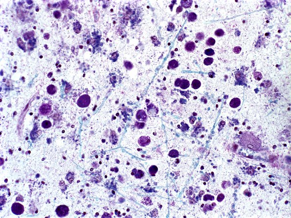 1C4 Metachromatic Leukodystrophy (Case 1) LFB-PAS 2