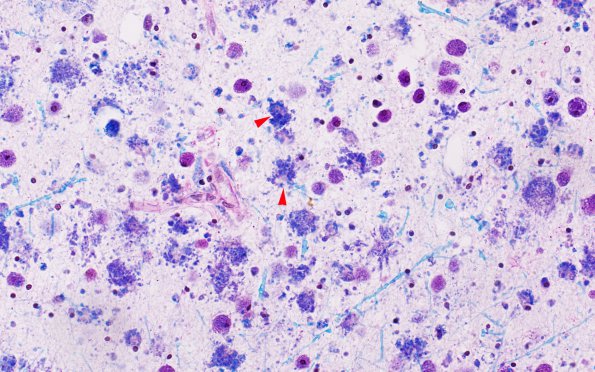 1C5 Metachromatic Leukodystrophy (Case 1) Cortex 2 9839 40X copy