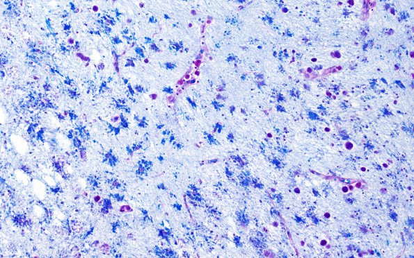 1C7 Metachromatic Leukodystrophy (Case 1) cortex 9833 40X A