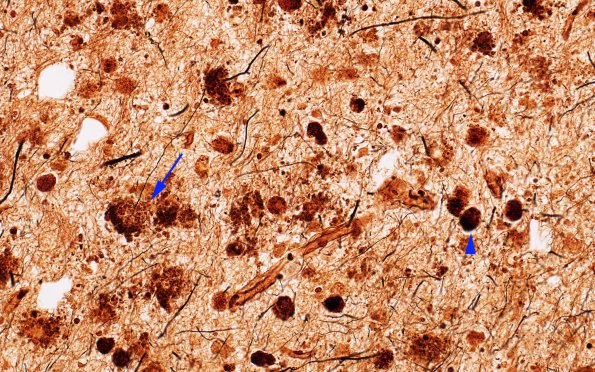 1D2 Metachromatic Leukodystrophy (Case 1) Cortex 2 9840 40X copy