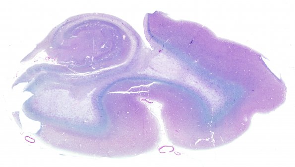 1D3 Metachromatic Leukodystrophy (Case 1) 1 LFB-PAS WM