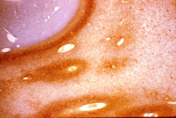 1E Metachromatic Leukodystrophy (Case 1) Hirsch-Peiffer 1