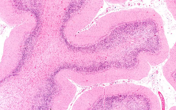 1F1 Metachromatic Leukodystrophy (Case 1) cerebellum 9821 4X (2)