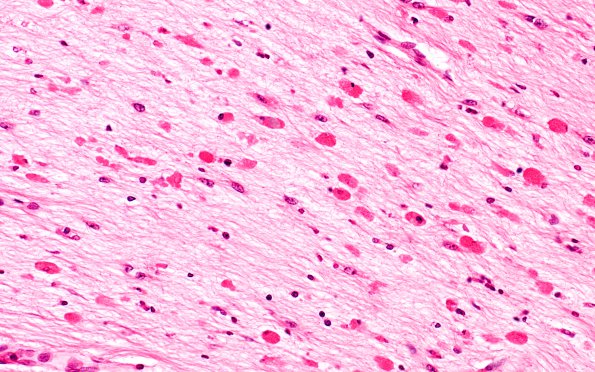 1F2 Metachromatic Leukodystrophy (Case 1) cerebellum 9824 40X