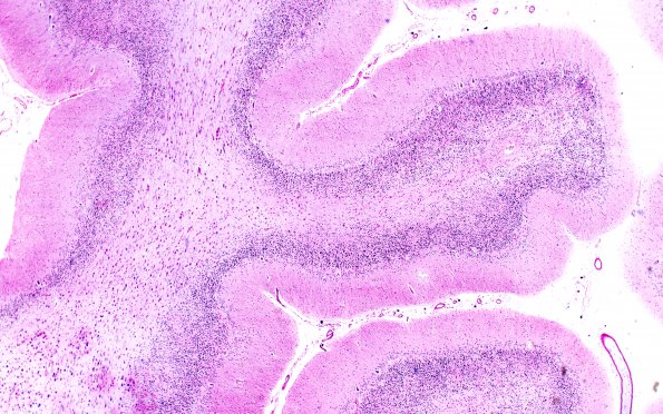 1F3 Metachromatic Leukodystrophy (Case 1) cerebellum 9820 4X